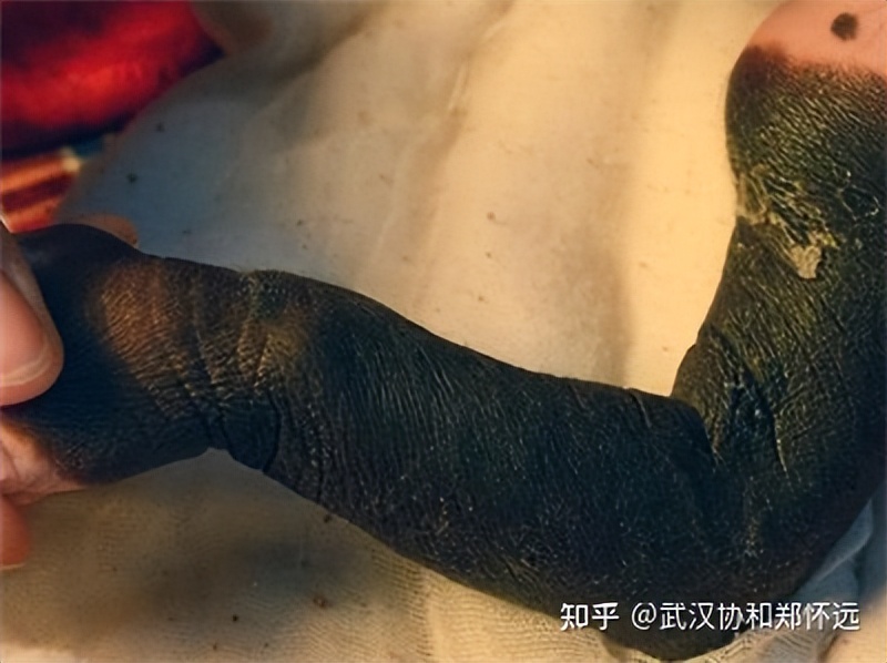 文东恩的伤疤令人心惊，身上的兽皮痣到底要不要治？