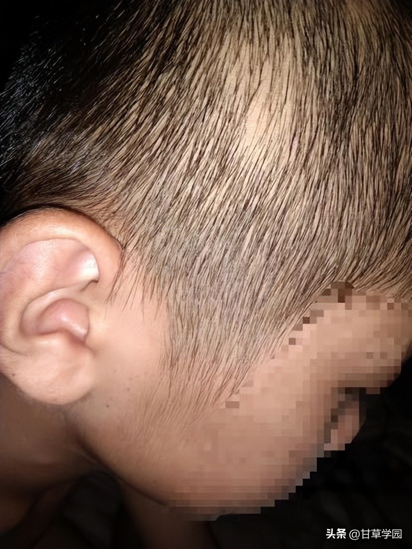 复方甘草治疗斑秃,甘草煮水治疗斑秃效果好吗