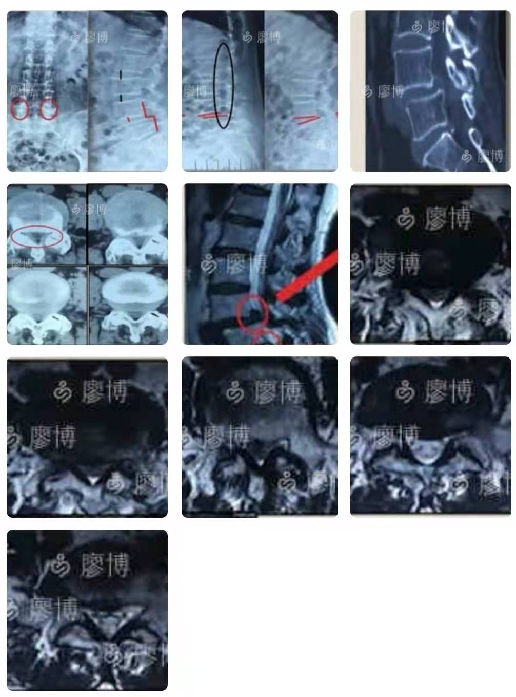 olif治疗腰椎滑脱有效吗,olif腰椎融合手术国内哪里做的好