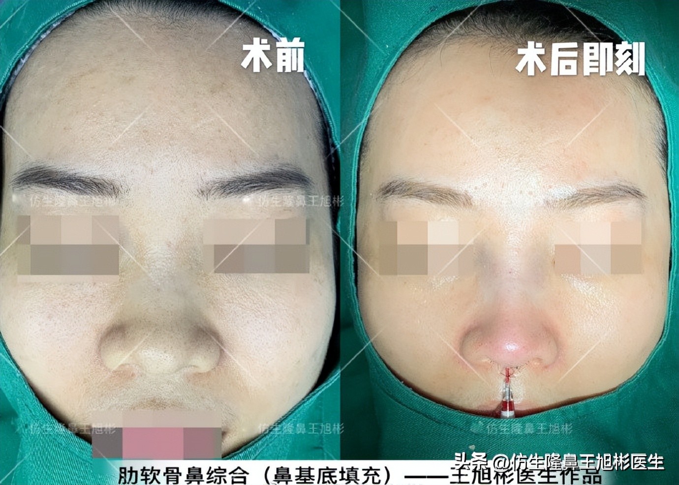 大鼻头能做直鼻微翘吗,可以只做鼻头缩小术吗