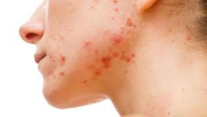 长痘痘哪些日常食物不能吃,长痘痘哪些食物不能吃