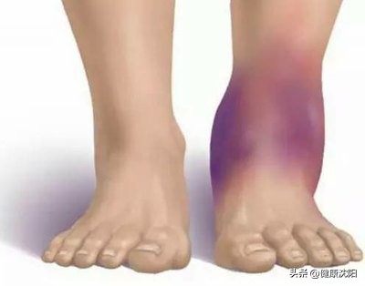 体育保健学崴脚急救措施,崴脚康复后怎么加强预防