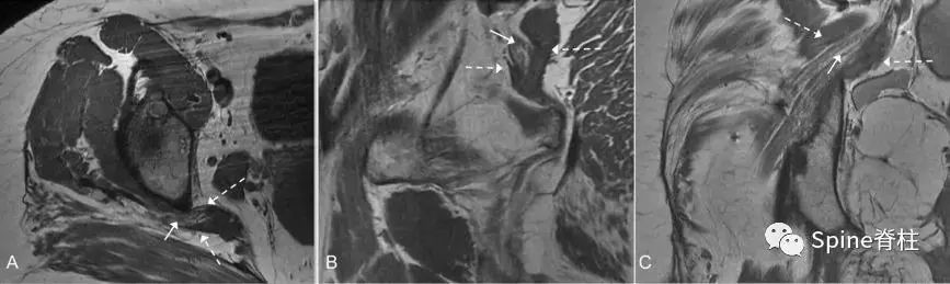 针灸治疗梨状肌综合征,一文了解贲门失弛缓症