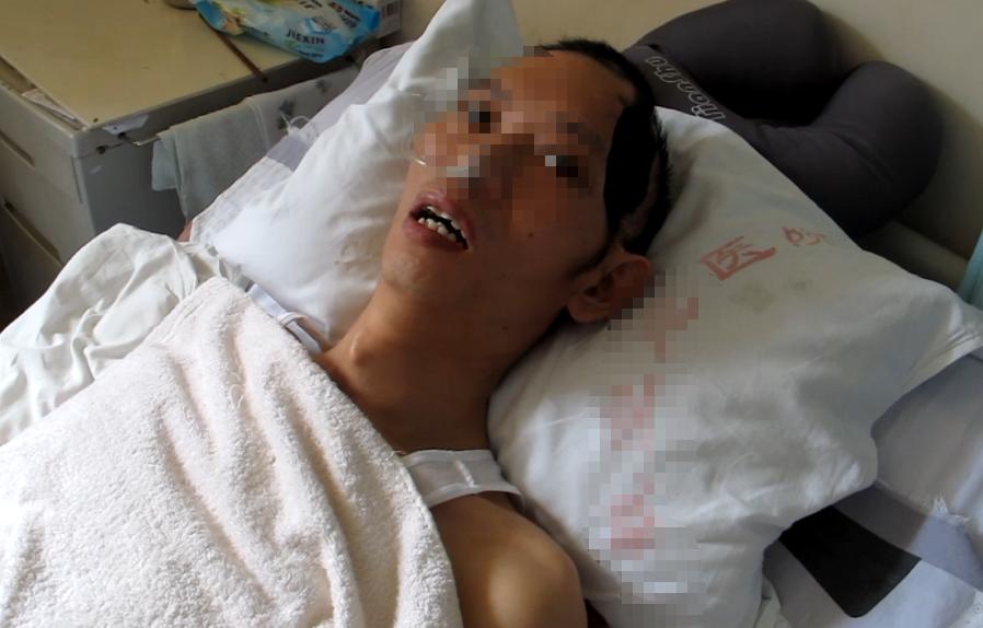 脑外伤开颅手术后继发癫痫,开颅术后颅内感染