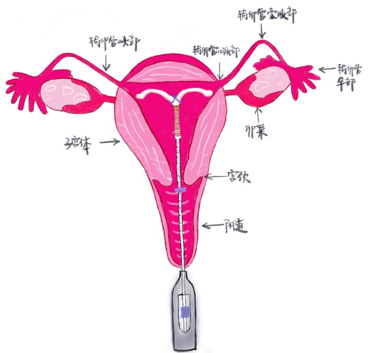 水手环的功效和作用,小小的环是怎么避孕的
