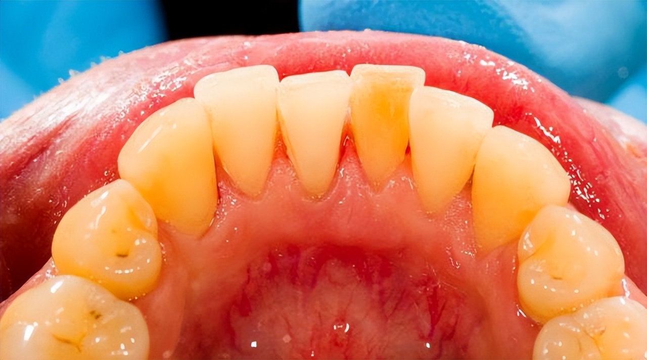 牙结石能直接抠下来吗,为什么牙结石可以用手抠出来