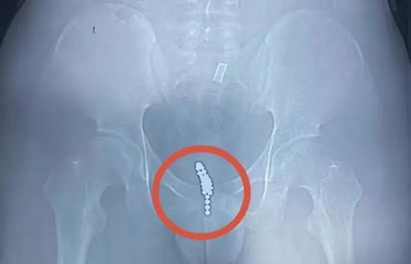 13岁男孩把1000颗磁力珠塞进管道,浙江14岁男孩体内取出19颗磁力珠