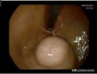 胃粘膜下肿物是什么意思,胃黏膜下肿物是癌症吗