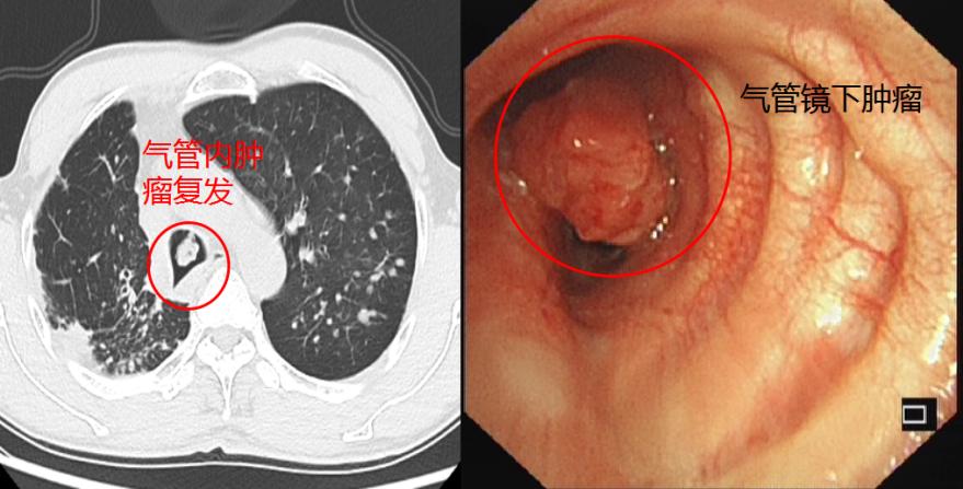 气管镜下肿瘤怎么治疗,气管肿物是什么