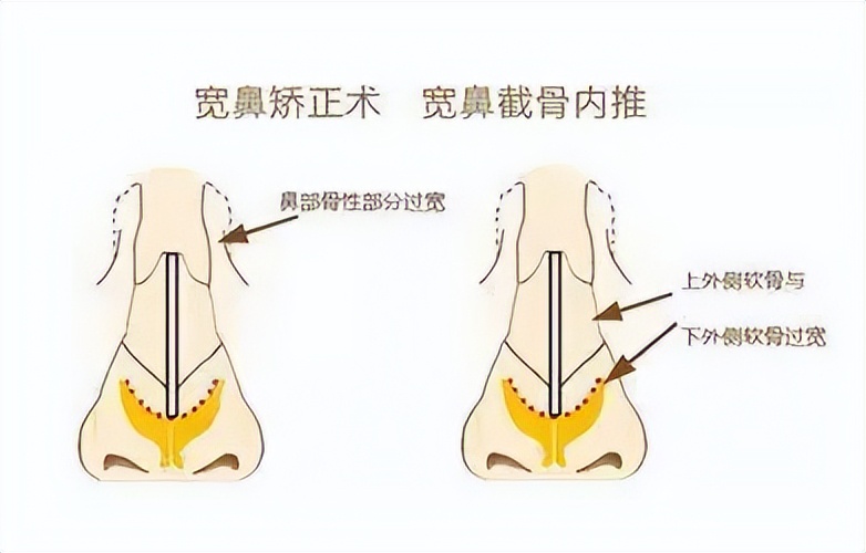 九院韦敏介绍,九院韦敏隆鼻多少钱