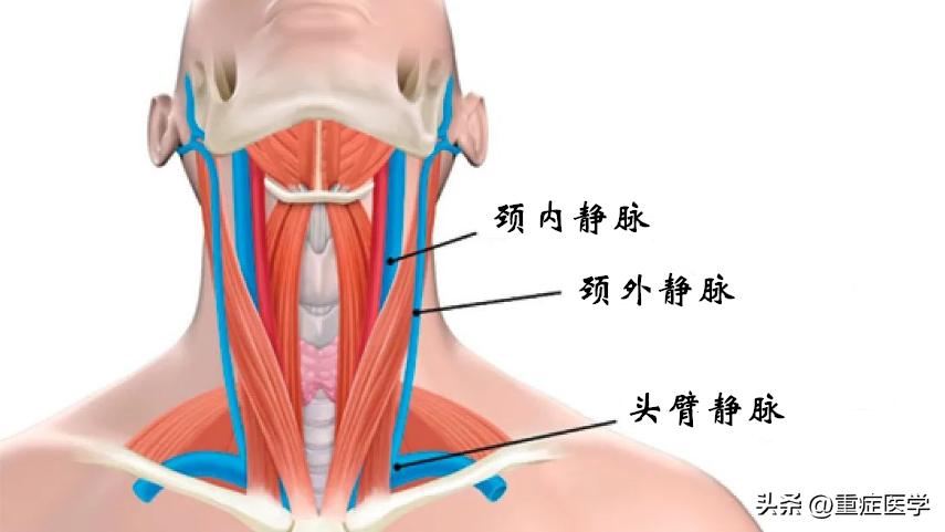 保姆级深静脉穿刺全攻略，建议收藏！