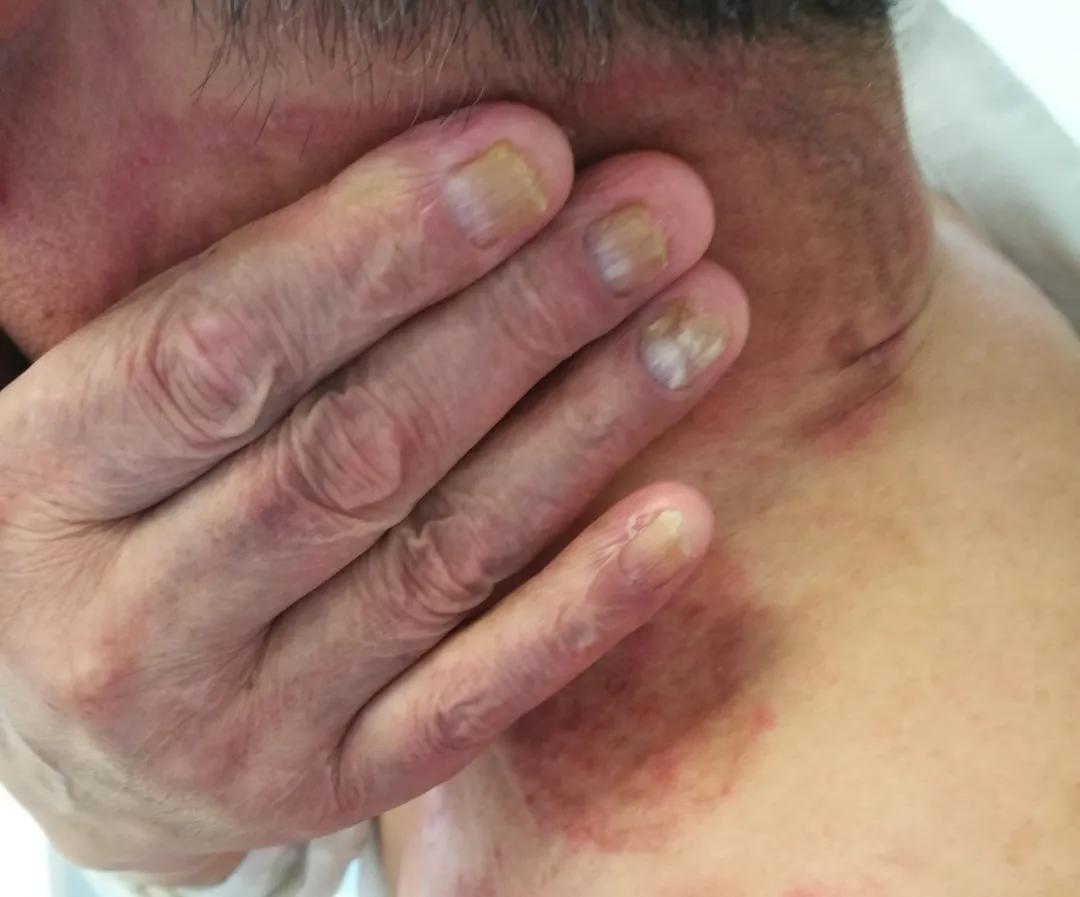 汗斑跟花斑癣,汗斑和花斑糠疹区别