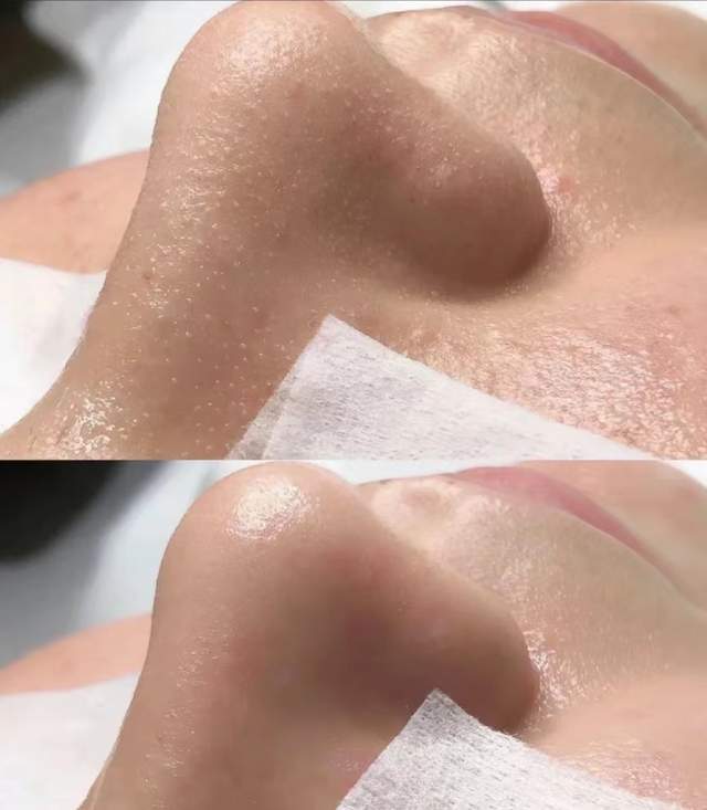 清洁面膜可以去黑头粉刺闭口吗,清洁面膜可以去除黑头吗