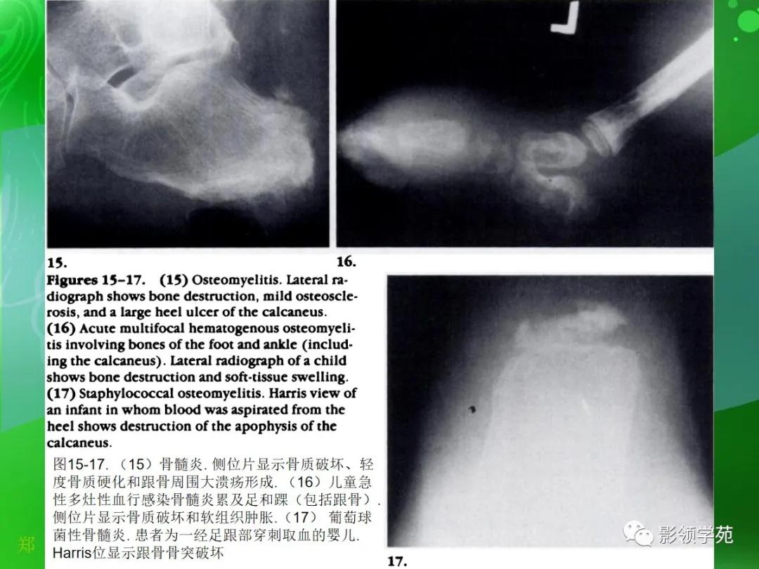 正常跟骨影像图,跟骨正常与变异影像表现图片
