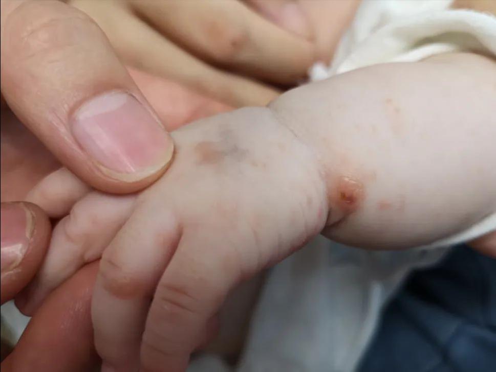 脖子前边痒是生病的前兆,腋窝和脖子痒是什么病的前兆