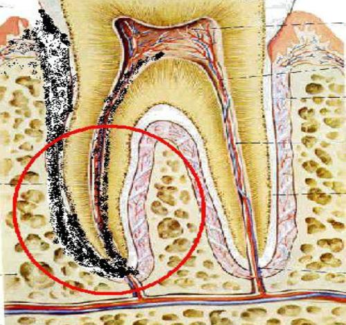 牙痛感觉牙齿如风一样什么情况,平时牙不疼但一嚼东西就疼