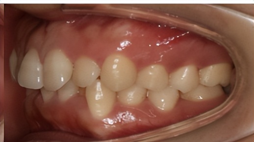 暑期牙齿矫正黄金季,牙齿矫正省钱攻略