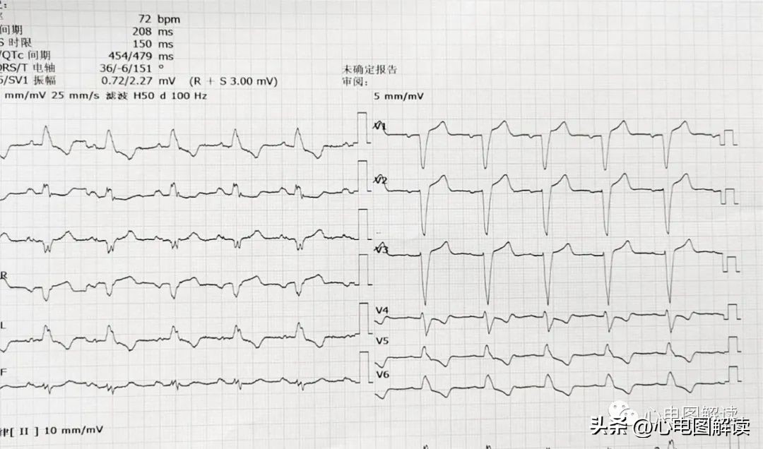II、III、aVF导联的正常q波、异常Q波