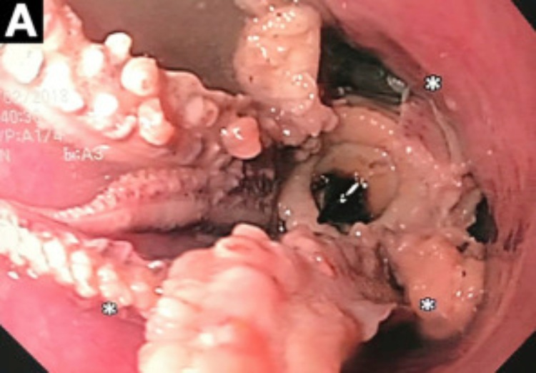 吃活章鱼被卡在喉咙里,章鱼卡住喉咙