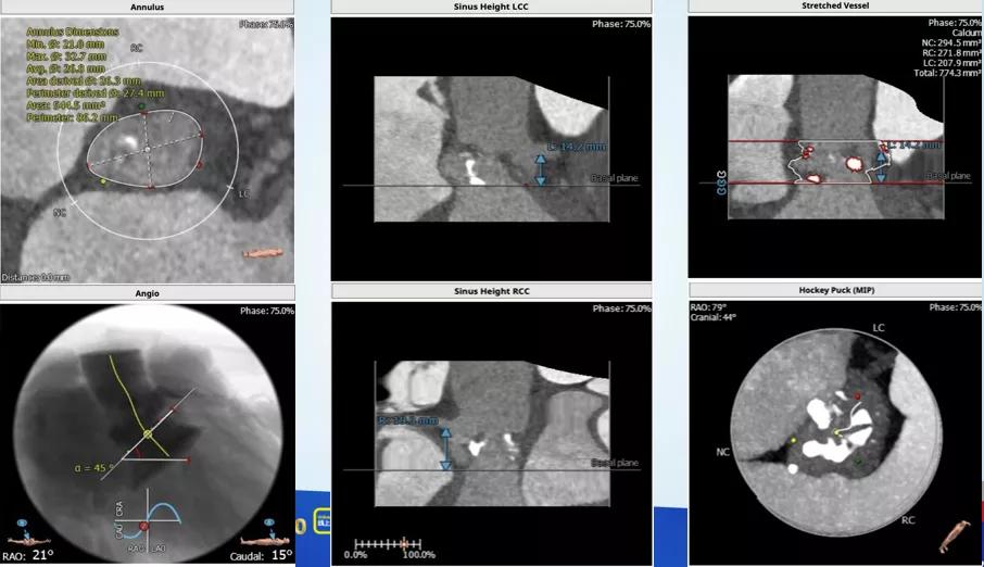 病例回顾与分享,腹膜后血肿介入治疗