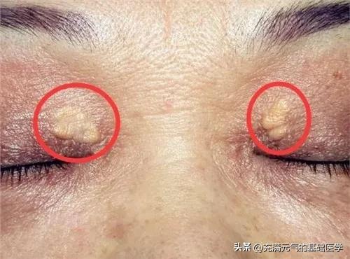 你见过吗，一些中年女性眼睑黄黄的两坨