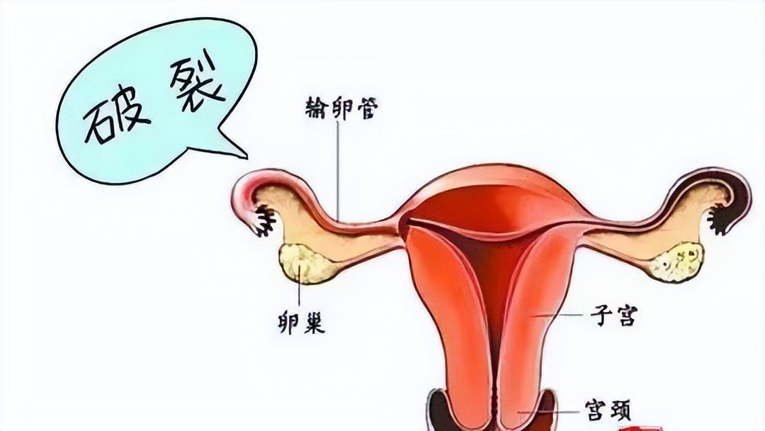 同房后酿成的悲剧：黄体破裂，夫妻生活不是打仗，要适度而行！