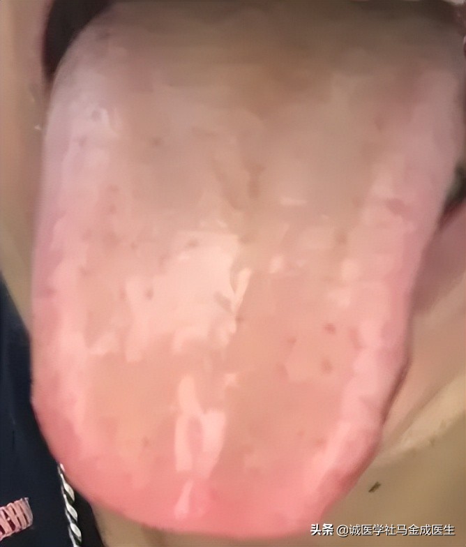 脾胃湿热去胃火吃什么中成药,脾胃湿热胃火炽盛怎么调理