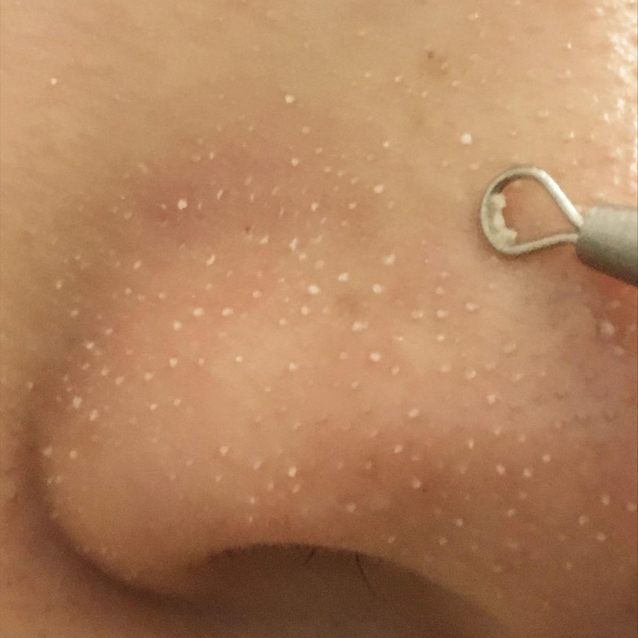 鼻子上好多黑头把毛孔堵住了,鼻子上的黑头怎么去除最有效方法