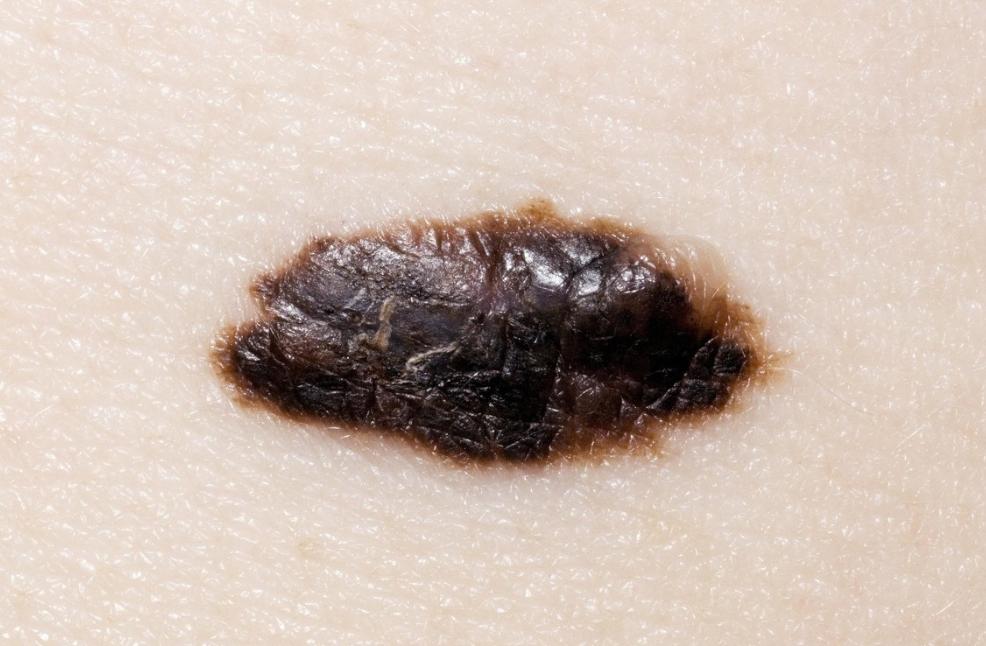 警惕这些痣可能会成瘤,哪些地方有痣代表得癌症了