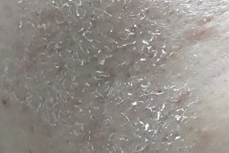 皮肤干燥刺痛用什么护肤品,脱皮刺痛泛红用什么护肤品