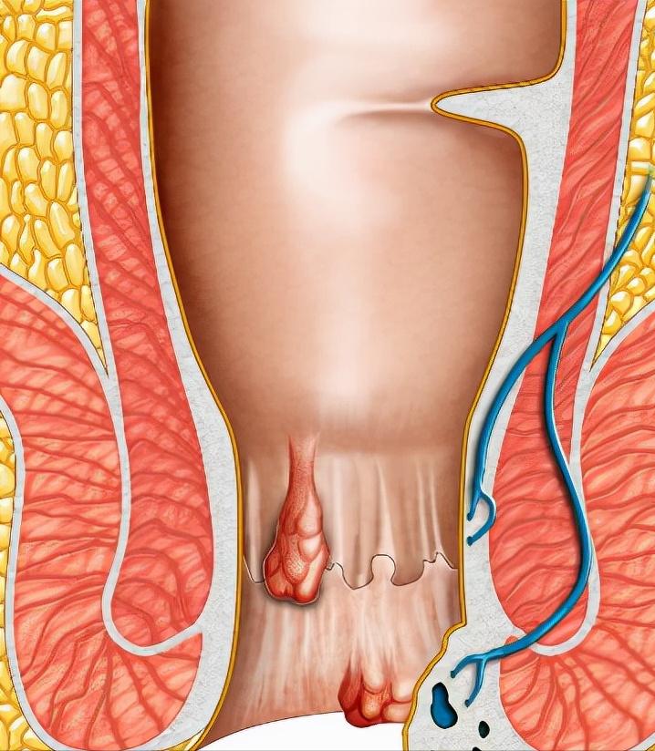 脱肛开始是什么样的,脱肛的原因及解决方法图