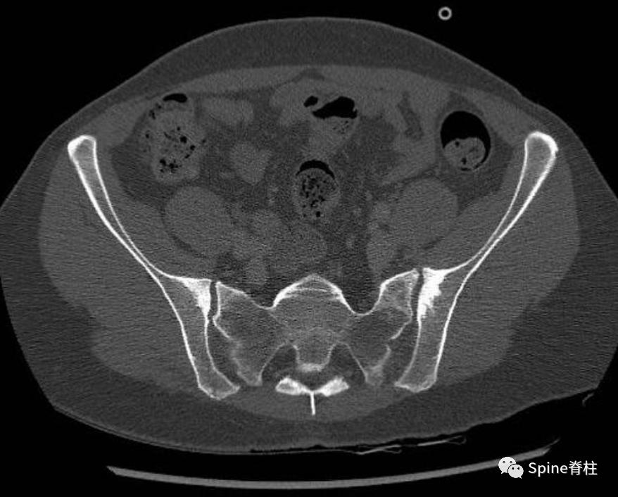 女性慢性腰痛谨防致密性髂骨炎,产后腰痛要做什么检查