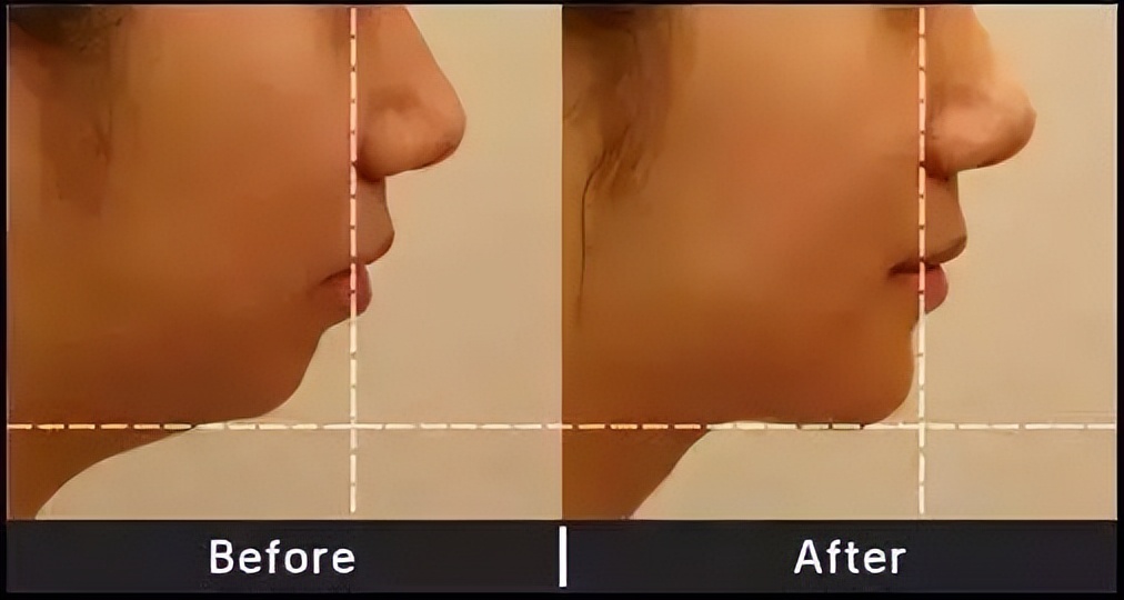 睡觉姿势错误会大小脸吗,睡姿不当会导致大小眼吗