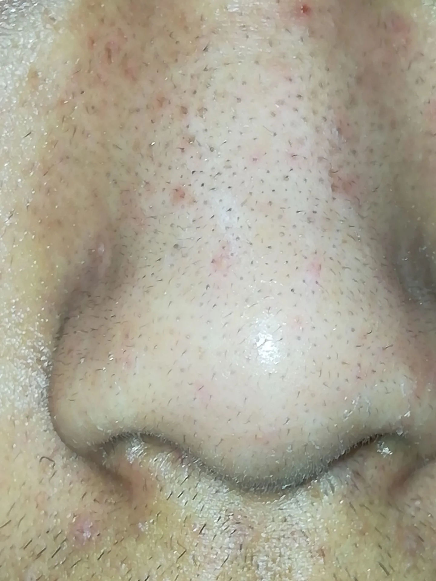 真黑头怎么去,黑头用黑头膏为什么去不掉黑头