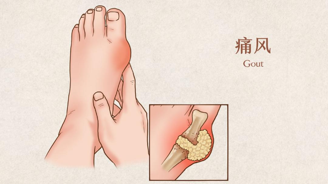 尿酸高是什么原因引起的,尿酸高怎么办中医