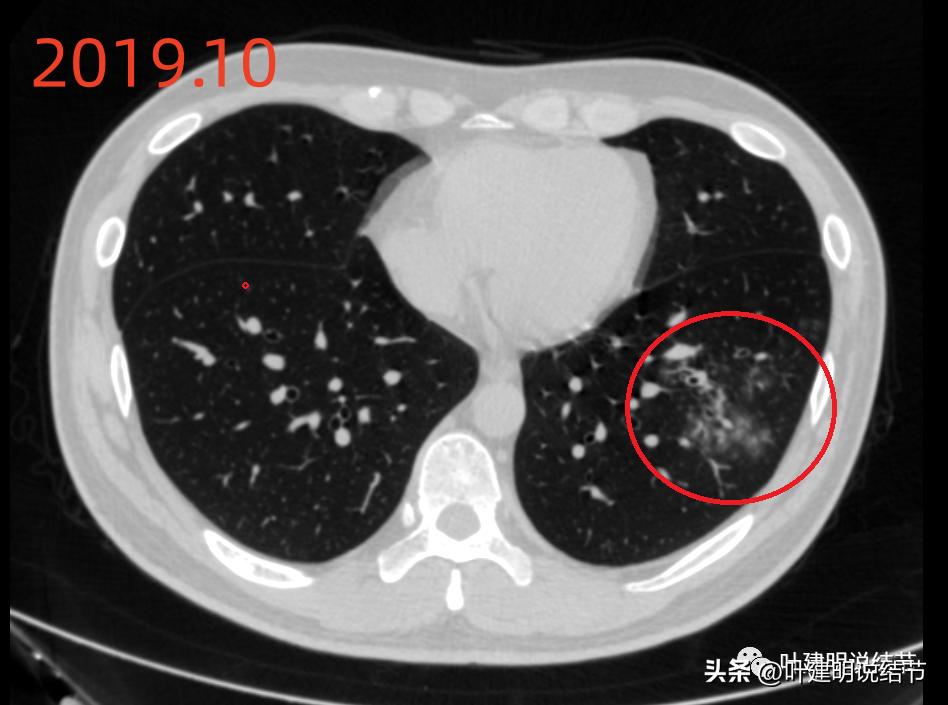 肺炎好了磨玻璃结节还存在,球形肺炎治愈后肺部留有结节