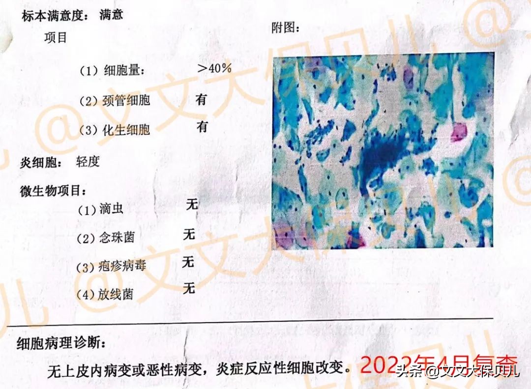 cin2-3累及腺体是宫颈癌吗,cin3级并累及腺体到宫颈癌多久