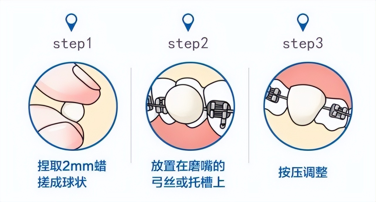 金属自锁托槽经常口腔溃疡怎么办,戴托槽要怎么防止口腔溃疡