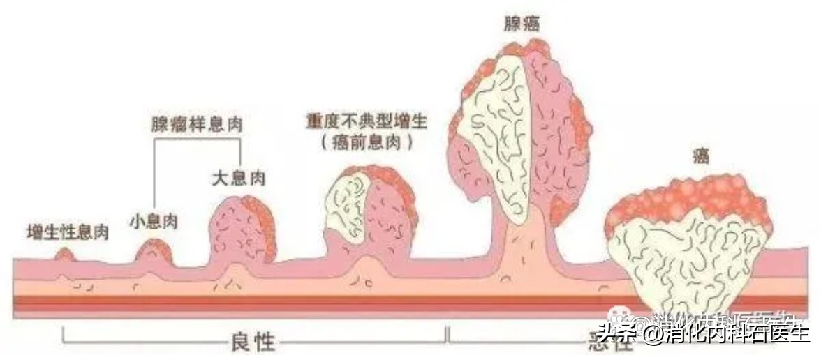 儿童肠息肉2.5公分,小孩结肠息肉用b超能查出来吗