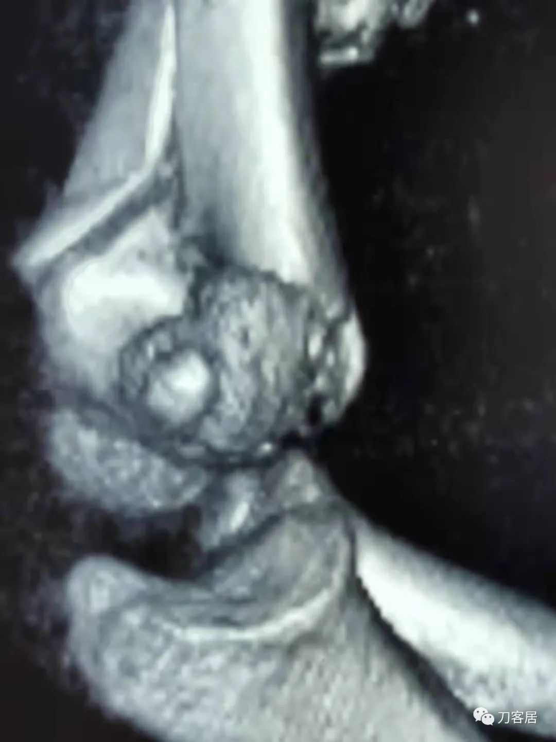 孩子胳膊摔伤肿了不能弯曲一直疼,9岁男孩摔倒手臂痛怎么办