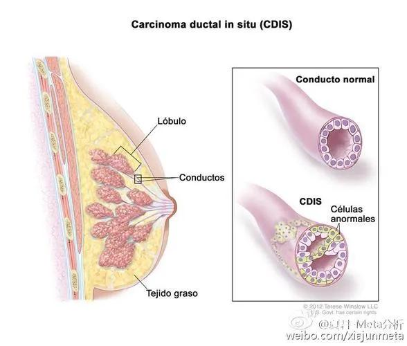 浸润性乳腺导管癌一期能治疗好吗,浸润性导管癌和小叶癌预后哪个好