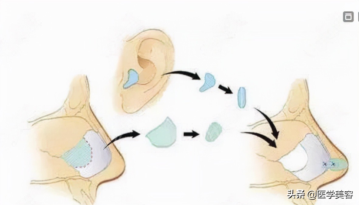 耳软骨隆鼻会被吸收吗,用耳软骨隆鼻还需要加别的材料吗