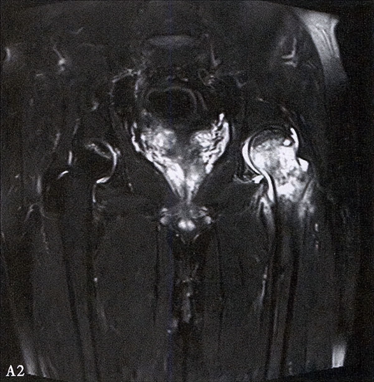 全国十大股骨头坏死诊疗中心,股骨头坏死诊疗方法有哪些