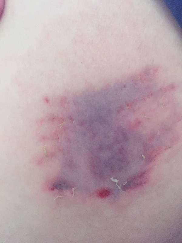 体内淤血怎么消除,气滞血瘀的这些淤血从哪里排出