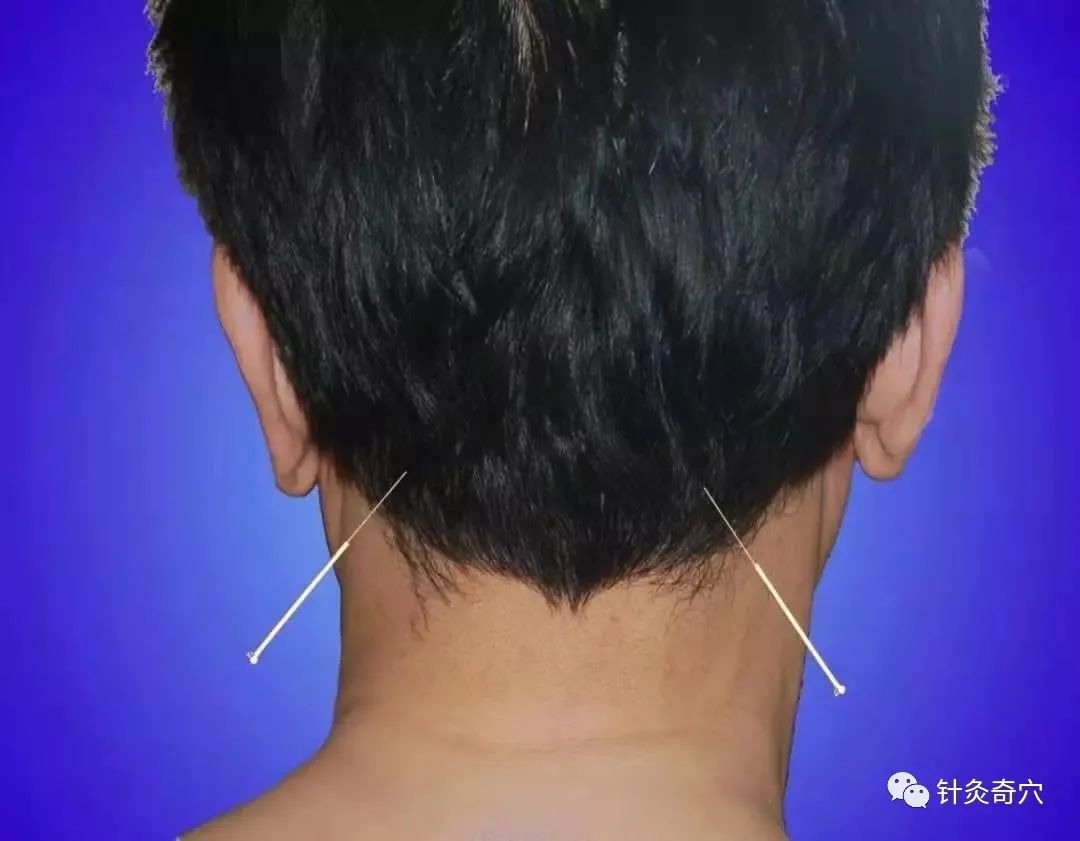 史上最全中医针灸视频教程全集,针灸治疗真实图片大全