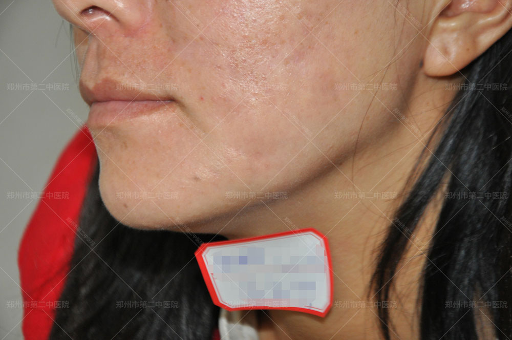 郑州市第二中医院疤痕科有效果吗,郑州市第二中医院疤痕增生怎么办