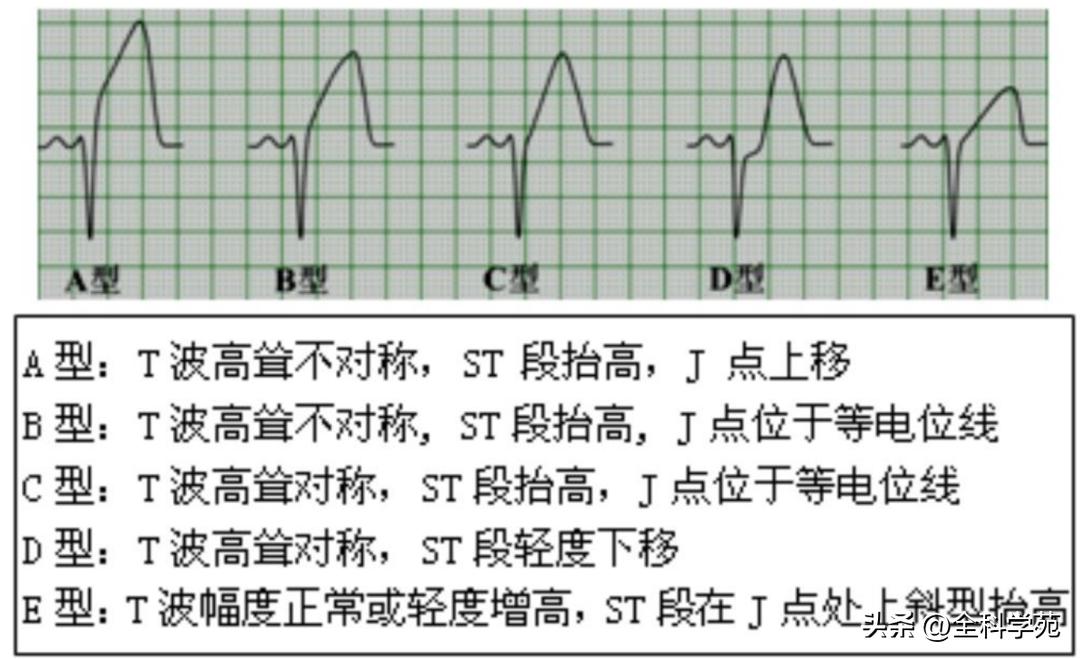 t波高尖心电图判断标准,t波高尖判断标准