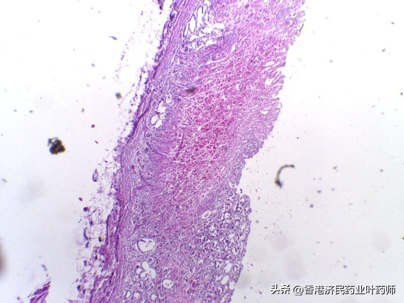 奥美拉唑治疗胃溃疡研究进展综述,奥美拉唑治疗胃溃疡研究文献综述