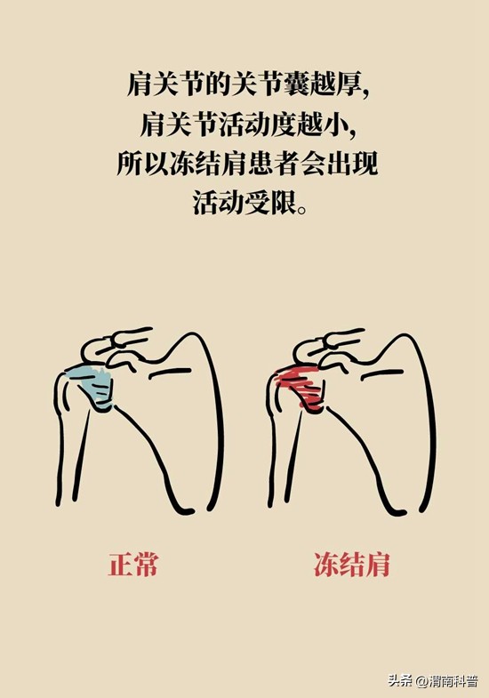 肩膀不抻不疼一抻就疼,肩膀往后伸疼