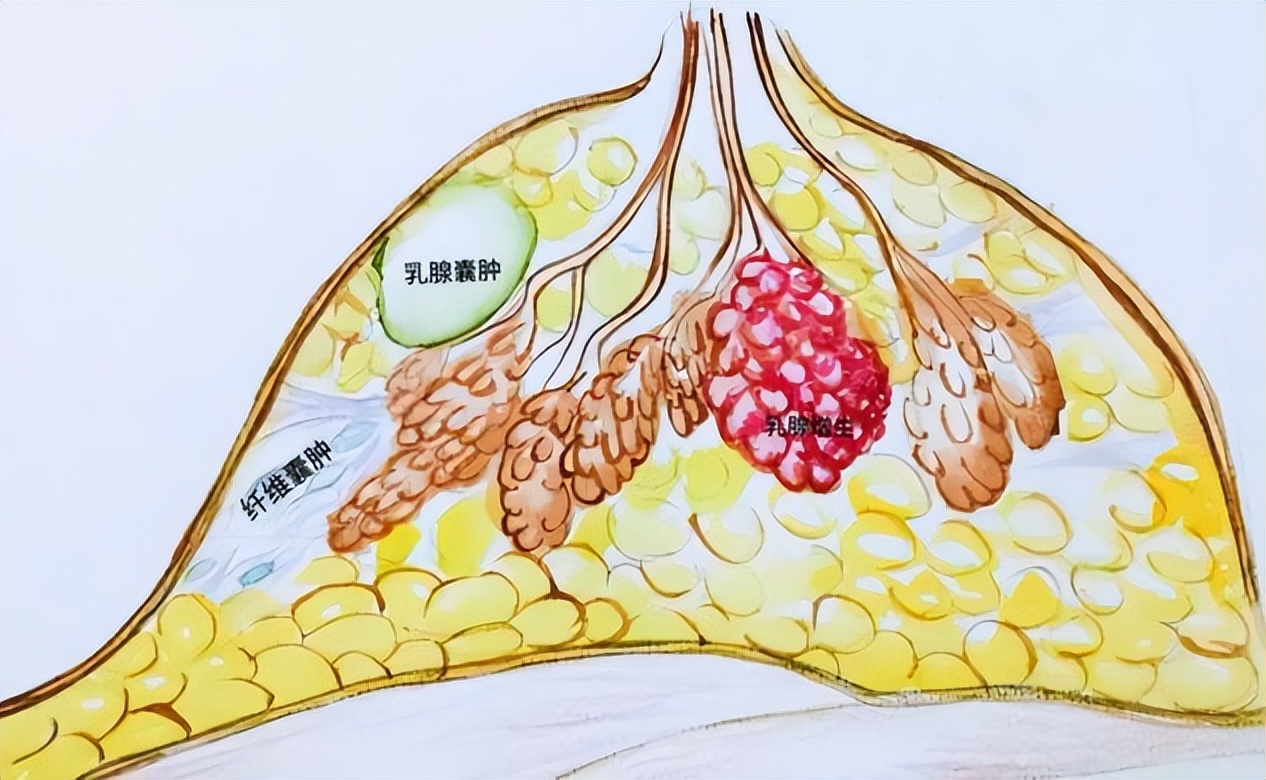 乳腺囊肿有肿块怎么办,乳腺增生囊肿疼痛严重怎么办